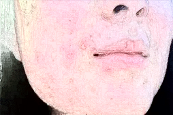 青島市立醫(yī)院面部吸脂收費價格?面部吸脂多久消腫