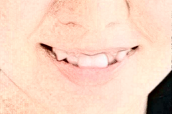 沈陽盛京醫(yī)院根管價(jià)格多少_真實(shí)案例分享