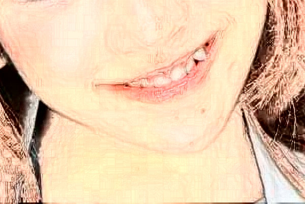 天津市第三中心醫(yī)院口腔科根管做的好嗎？根管整形日記