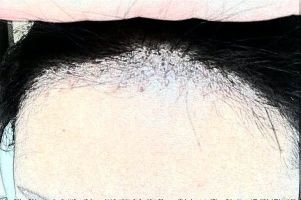 2024延邊醫(yī)院植發(fā)怎么樣?全新案例分享