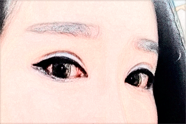 2024安徽省立醫(yī)院填充淚溝需要多少錢(qián)?醫(yī)生推薦