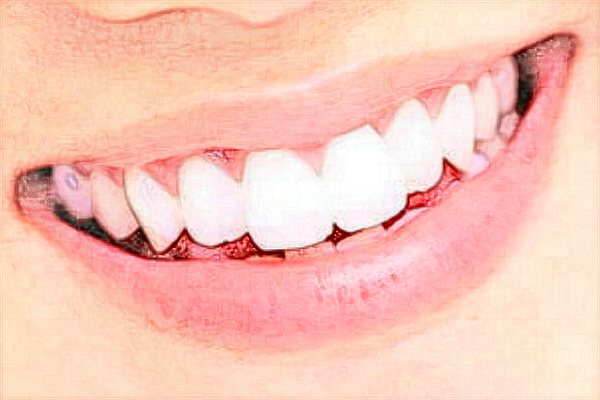 2024蘭州大學(xué)第二醫(yī)院拔智齒費(fèi)用?拔智齒注意事項與禁忌