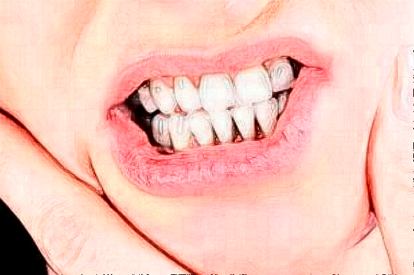 溫州醫(yī)學院附屬第二醫(yī)院口腔科烤瓷牙做的怎么樣_誰做的比較好