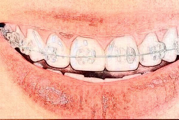 2024山西醫(yī)科大學(xué)第一醫(yī)院口腔科牙列畸形正畸價目表(價格表)怎么樣