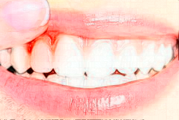 2024大連大學附屬新華醫(yī)院隱形義齒好不好?體驗日記反饋