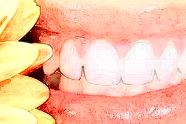 2024吉林大學(xué)第一醫(yī)院口腔科根管怎么樣_整形日記分享