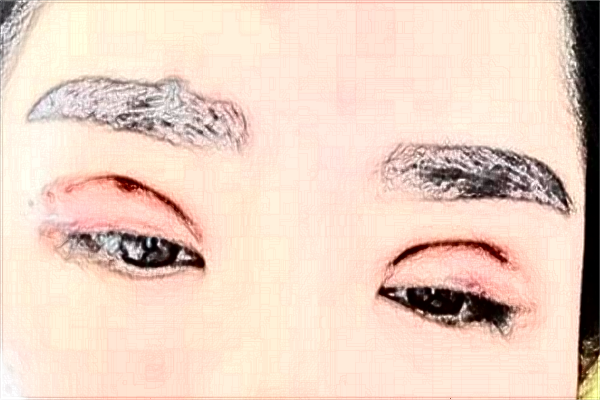 2024杭州市第一人民醫(yī)院埋線雙眼皮誰做得好_需要多少錢