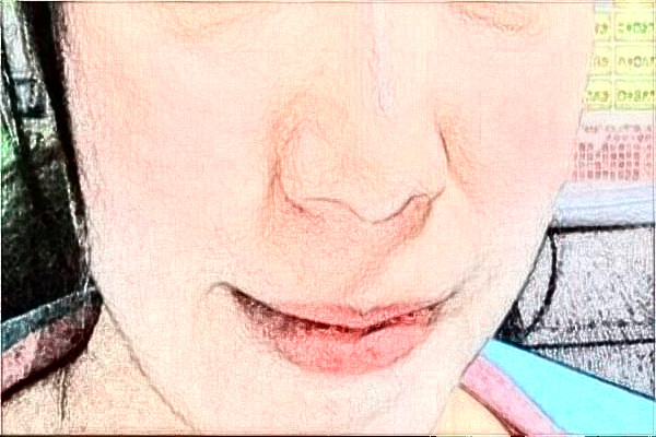 2024大連大學附屬新華醫(yī)院激光脫毛怎么樣?全新案例分享