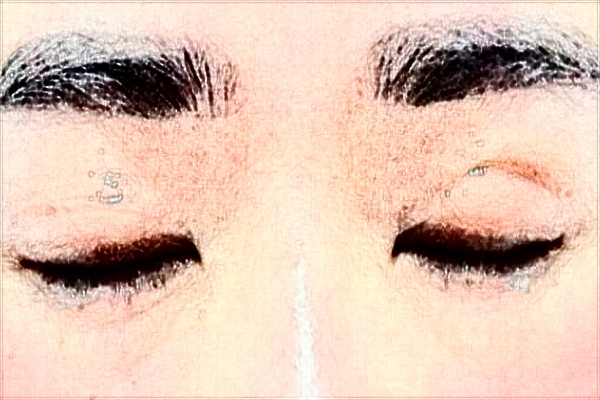 安徽醫(yī)科大學(xué)第一附屬醫(yī)院做雙眼皮價目表(價格表)怎么樣