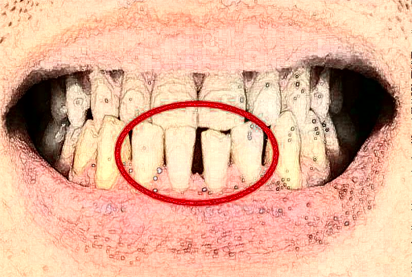 上海華美醫(yī)療美容醫(yī)院牙齒美容好嗎_真實案例發(fā)布