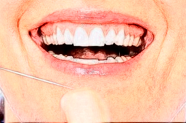 安徽省立醫(yī)院根管加牙冠多少錢(qián)?做的好嗎?