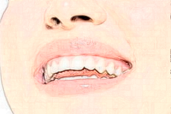 2024蘇北人民醫(yī)院義齒修復價目表_口碑怎么樣