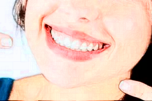 2024青島市立醫(yī)院隱適美價(jià)格?隱適美矯正牙齒利弊