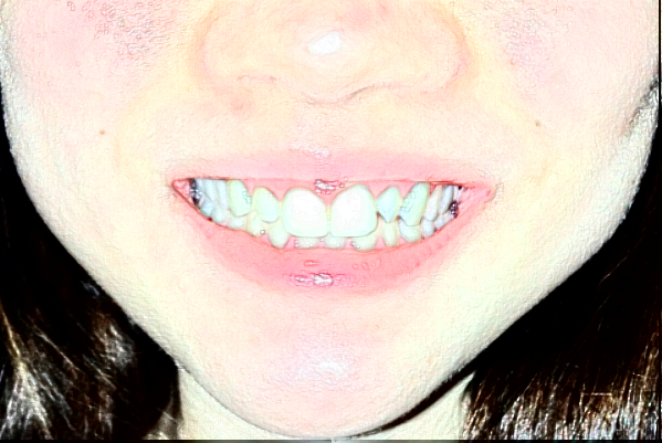 2024株洲市中心醫(yī)院牙齒矯正價(jià)格?牙齒矯正好處