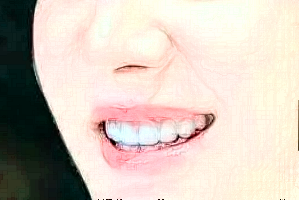 ?？谑腥嗣襻t(yī)院補牙哪個醫(yī)生好?補牙案例