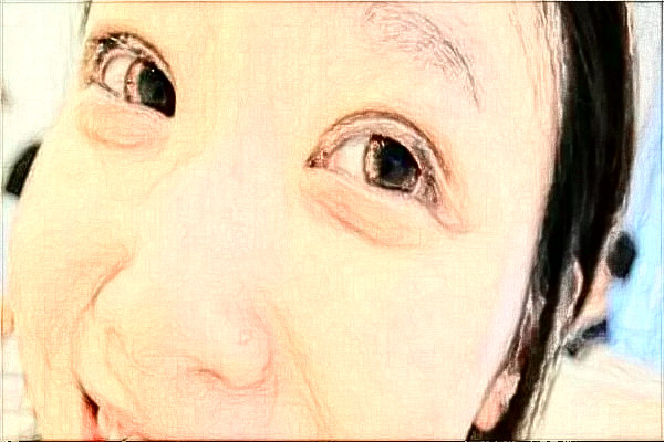 丹東市第一醫(yī)院割雙眼皮做的好嗎_案例_價格