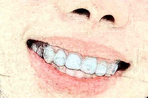 吉林大學(xué)第一醫(yī)院烤瓷牙怎么樣_整形日記分享