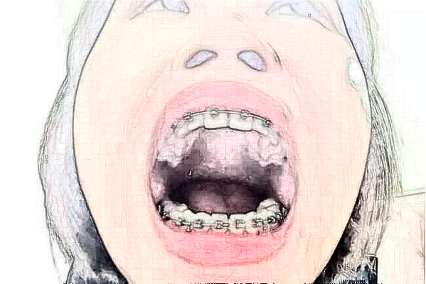 江蘇省人民醫(yī)院牙列不齊矯正怎么樣_誰(shuí)做得好