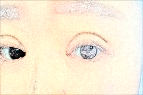 南通大學(xué)附屬醫(yī)院割雙眼皮價目表(價格表)怎么樣