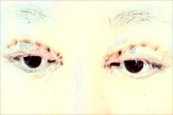 南通大學(xué)附屬醫(yī)院割雙眼皮價目表(價格表)怎么樣