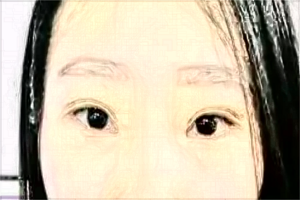 南通大學(xué)附屬醫(yī)院激光祛疤痕做的怎么樣_案例分享