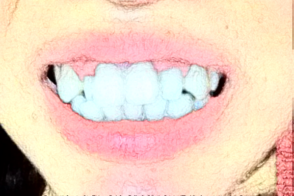 長沙科爾雅口腔醫(yī)院洗牙價(jià)格(價(jià)目)_案例_