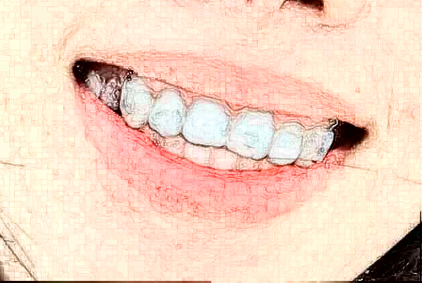 株洲市中心醫(yī)院牙矯正怎么樣?矯正牙齒要多久