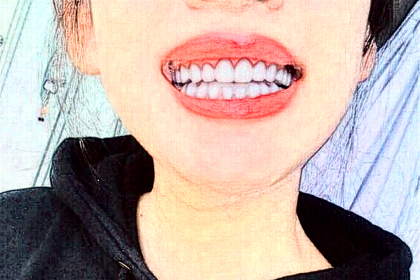 2024常德市第一人民醫(yī)院烤瓷牙多少錢一顆?烤瓷牙怎么樣?