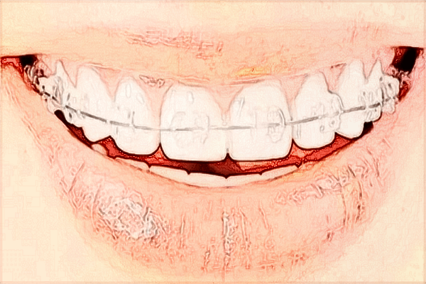 2024?？谑腥嗣襻t(yī)院牙齒矯正費用?牙齒矯正醫(yī)生技術(shù)好嗎