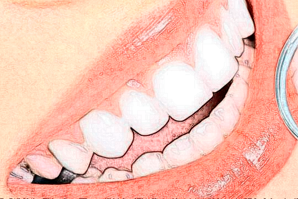 2024上海華美醫(yī)療美容醫(yī)院牙齒正畸費用多少_真實案例反饋