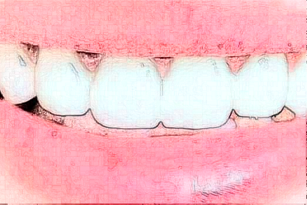 2024上海華美醫(yī)療美容醫(yī)院牙齒正畸費用多少_真實案例反饋