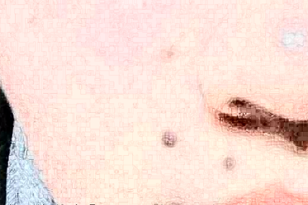 2024沈陽盛京醫(yī)院去痣好不好?體驗日記反饋