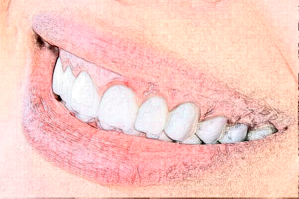 佛山市第二人民醫(yī)院牙齒根管哪個(gè)好?根管很痛嗎