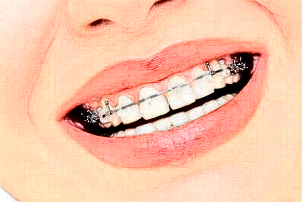 2024山西省人民醫(yī)院成人正畸價(jià)目表(價(jià)格表)_口碑怎么樣