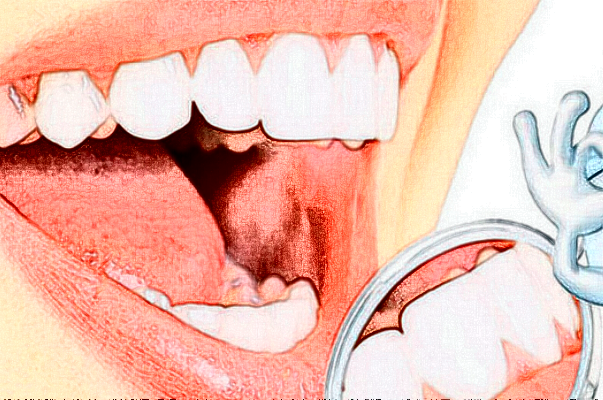 2024無(wú)錫市人民醫(yī)院烤瓷牙好嗎?附價(jià)格表+案例