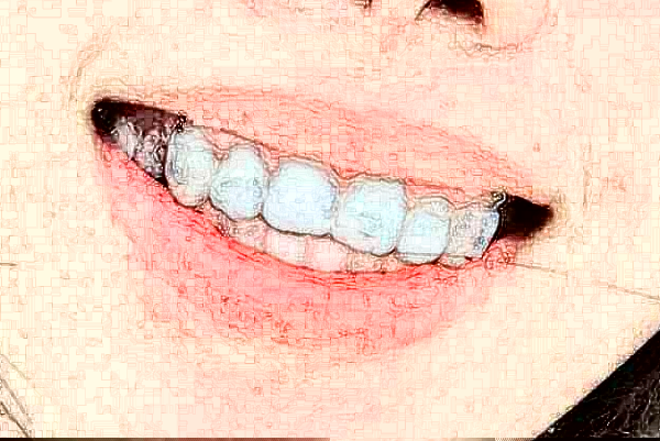 2024鄭州植得口腔醫(yī)院拔智齒多少錢(qián)?拔智齒疼嗎