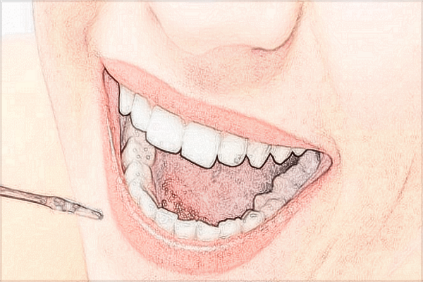 2024常德市第一人民醫(yī)院拔智齒多少錢?拔智齒注意事項(xiàng)