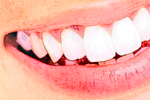 山西省人民醫(yī)院全口種植費(fèi)用多少?整形日記全過程