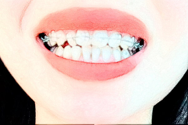 成都新橋口腔醫(yī)院種植牙技術如何?種植牙后遺癥