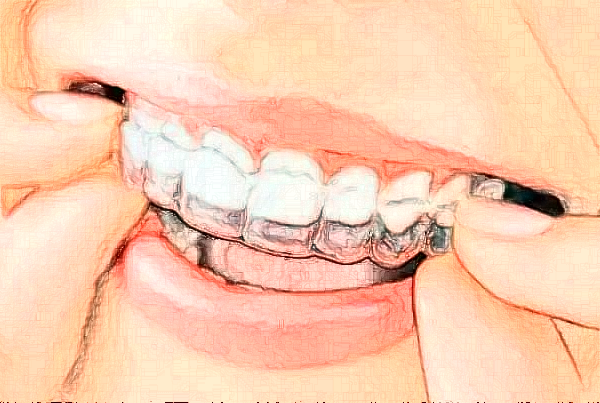 銅陵市人民醫(yī)院冷光美白怎么樣_案例分享