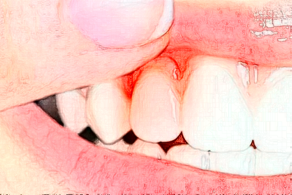 福州登特口腔醫(yī)院微創(chuàng)種植費用多少_醫(yī)生名單