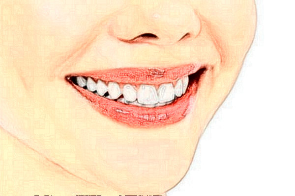 2024中山香山口腔醫(yī)院瓷貼面多少錢(qián)?瓷貼面牙齒有危害嗎