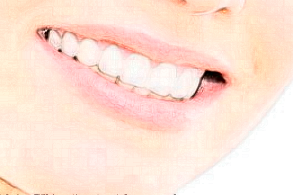 重慶團(tuán)圓口腔醫(yī)院拔智齒怎么樣?拔智齒要花多少錢(qián)?