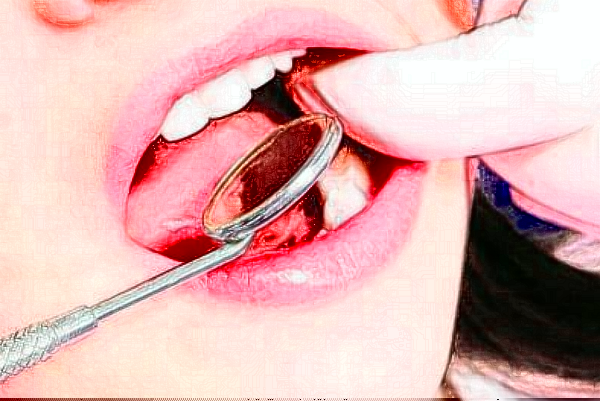 2024中山香山口腔醫(yī)院全瓷牙價格?全瓷牙會不會有后遺癥?