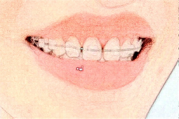 鄭州唯美口腔醫(yī)院正畸多少錢?做的怎么樣