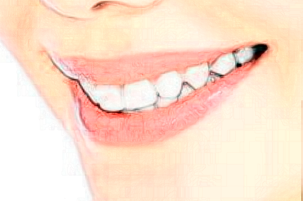 2024杭州雅萊口腔瓷貼面價(jià)格來(lái)咯!還有案例可以參考