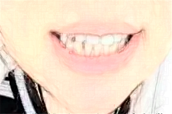 成都圣貝牙科醫(yī)院美容冠價格多少?整形日記全過程分享