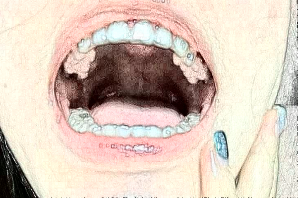 2024襄陽新德恩口腔門診部牙齒美白費(fèi)用多少_真實(shí)案例反饋
