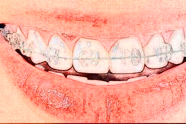 2024鄭州植得口腔醫(yī)院牙齒矯正多少錢?牙齒矯正的醫(yī)生