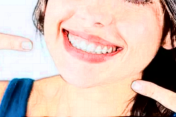 成都新橋口腔醫(yī)院種植牙醫(yī)生介紹?種植牙的壽命多久